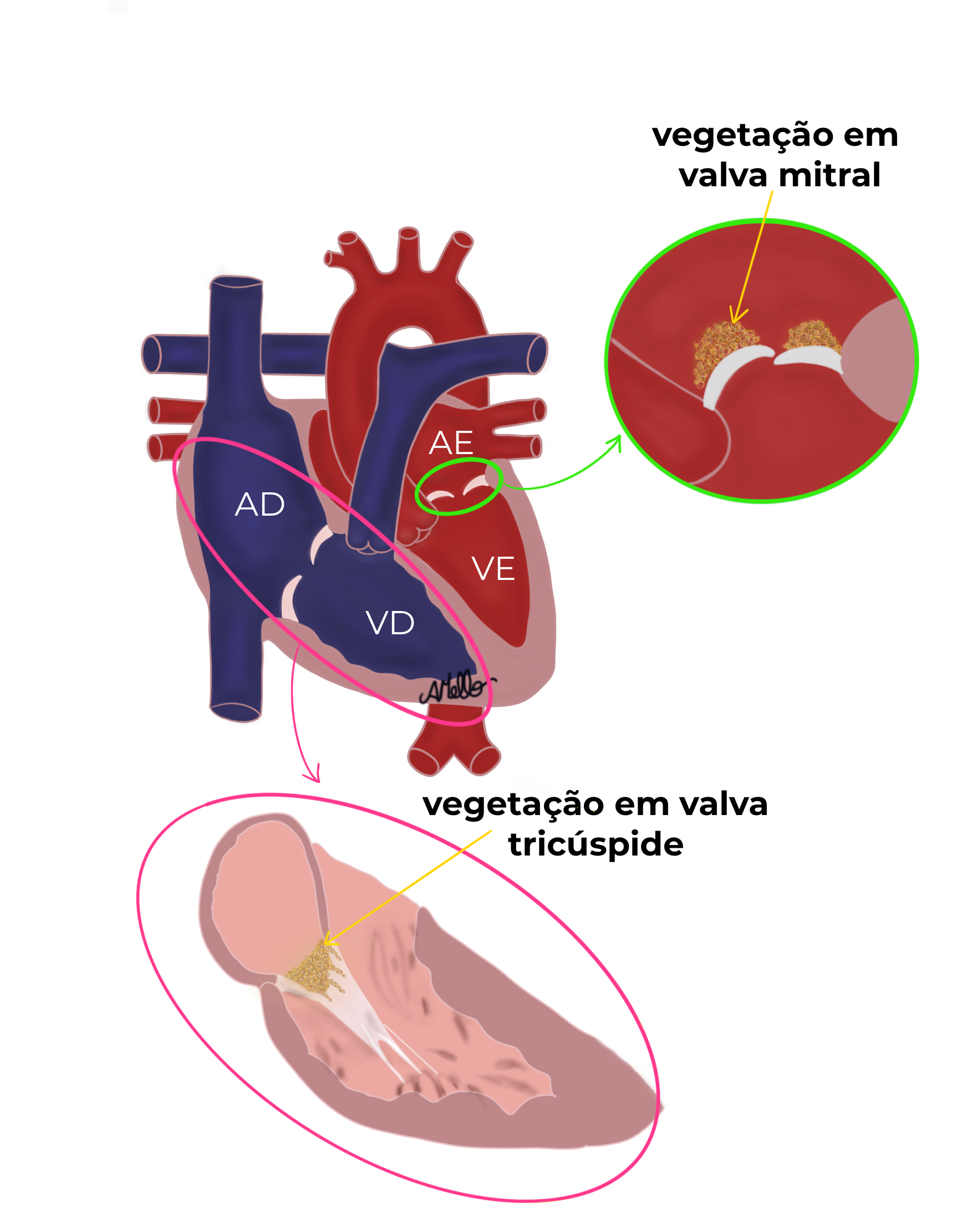 Endocardio - Esses sintomas combinados, podem ser indicativos