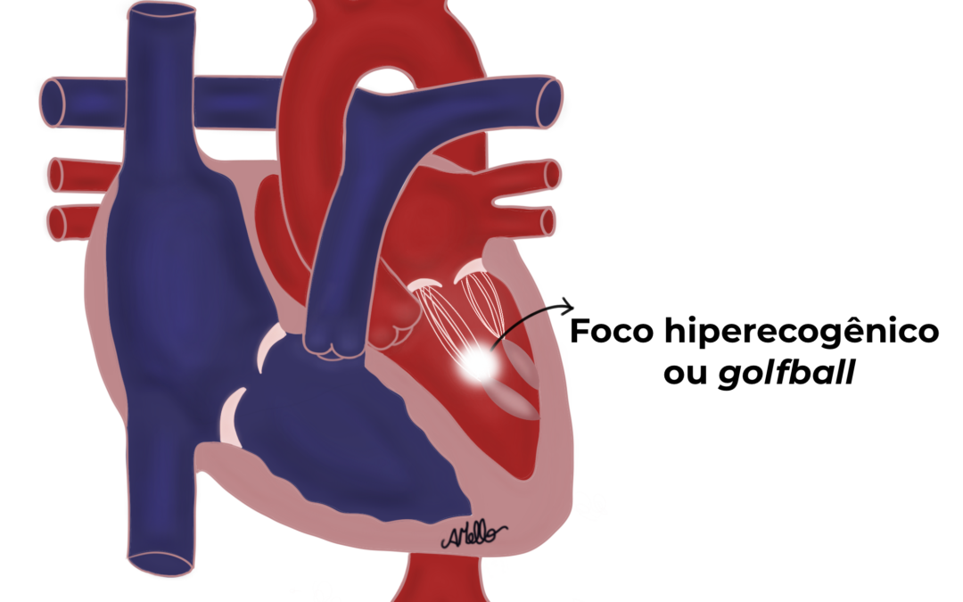 CORAÇÃO FETAL –  Golfball ou “bolinha de golfe”