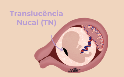 Translucência nucal (TN) aumentada