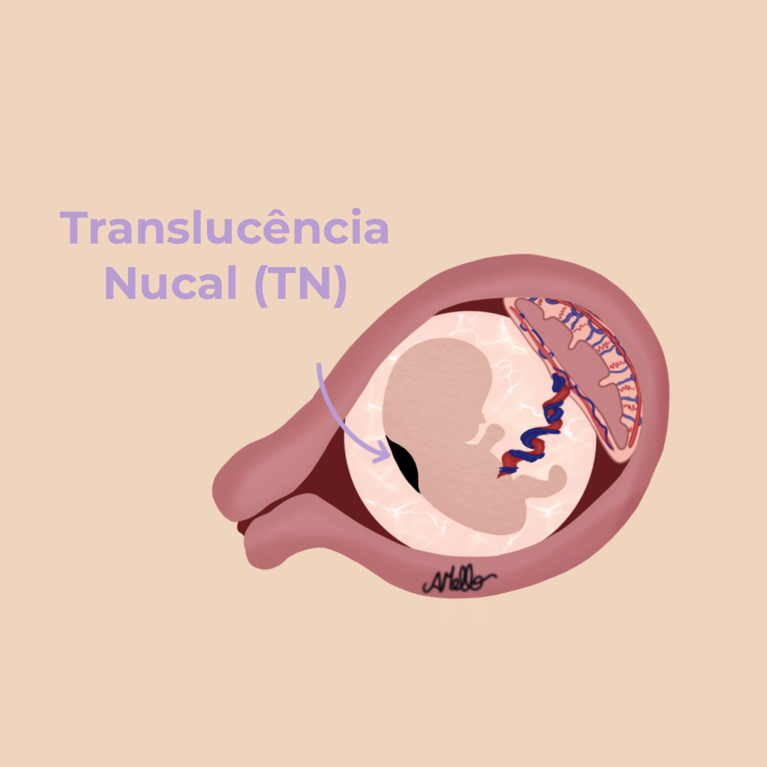 Translucência Nucal Tn Aumentada Adriana Mello 