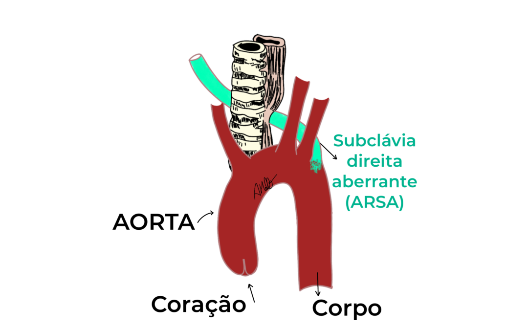 ARTÉRIA SUBCLÁVIA DIREITA ABERRANTE